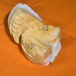 Tipi di impianti dentali: una introduzione