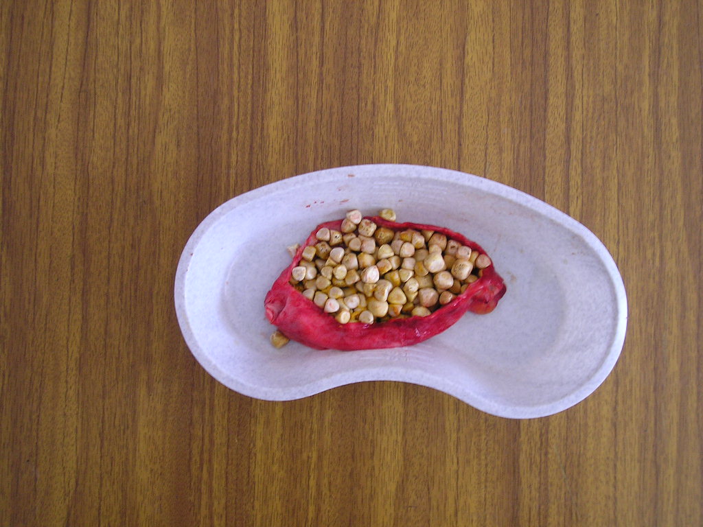 Calcoli alla cistifellea: Cause, sintomi e cura